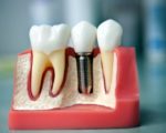 Зубы по технологии all-on-4 за 1 день